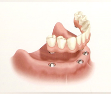 Implant Supported Fixed Bridge