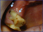 Splaying due to Tooth Loss