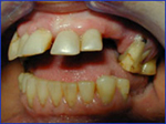 Tooth Loss Induced Splaying and Overeruption