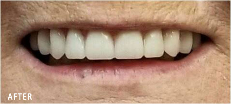Grace, All On Four Smile Recipient After
