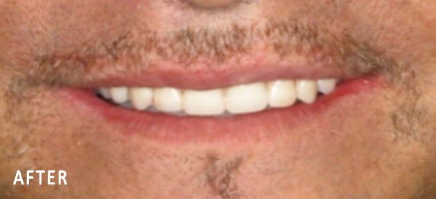 John, All On Four Smile Recipient After