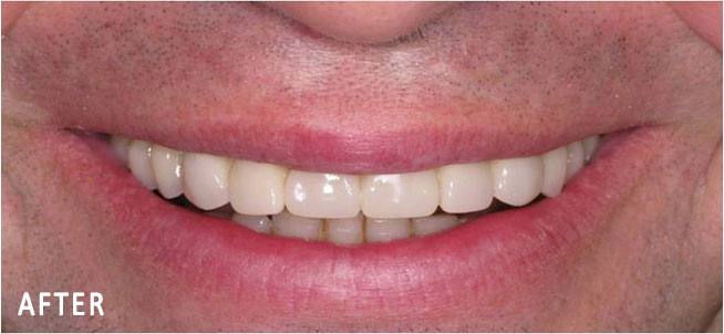 John, All On Four Smile Recipient After