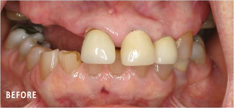 Grace, All On Four Smile Recipient Before