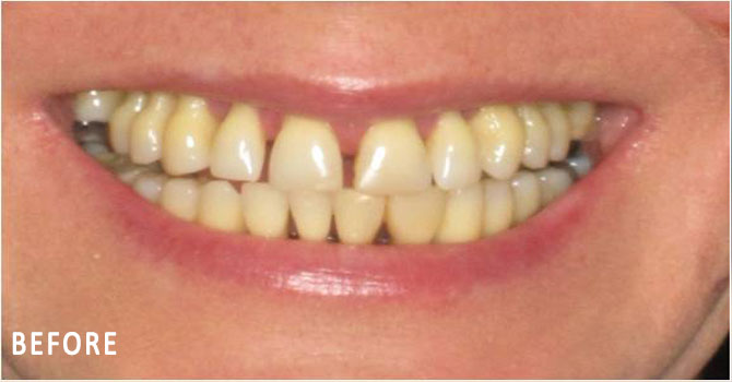 Emily, All On Four Smile Recipient Before