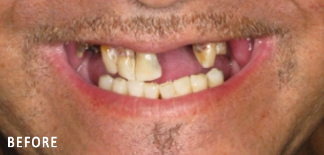 John, All On Four Smile Recipient Before