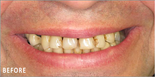 John, All On Four Smile Recipient Before