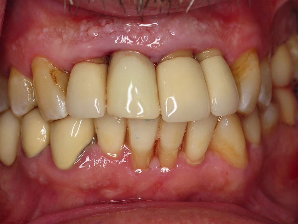 Broken Tooth Causing Pain Replaced with Dental Implant
