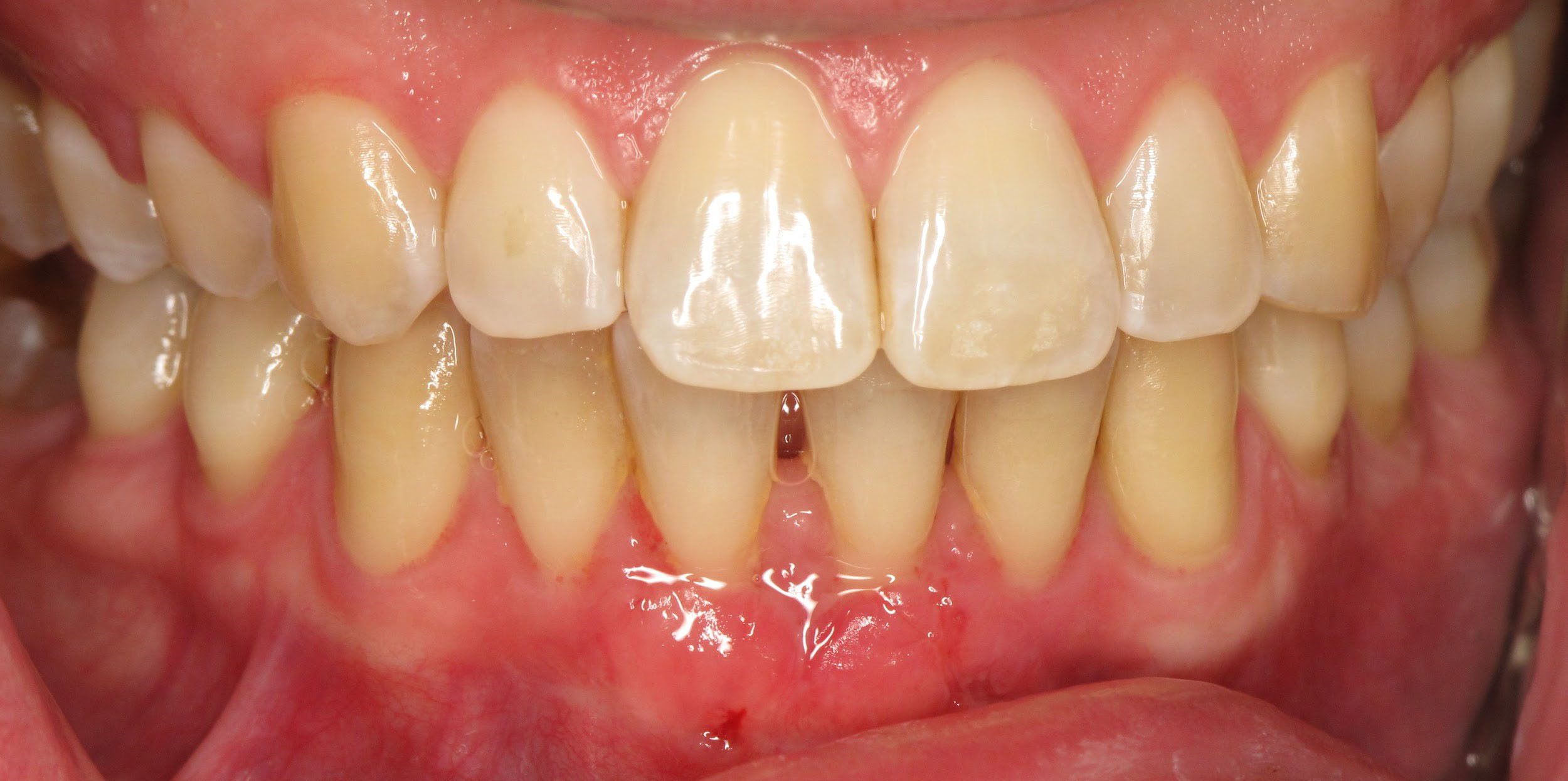 Tissue Graft Used for Patient in Pain Due to Recession