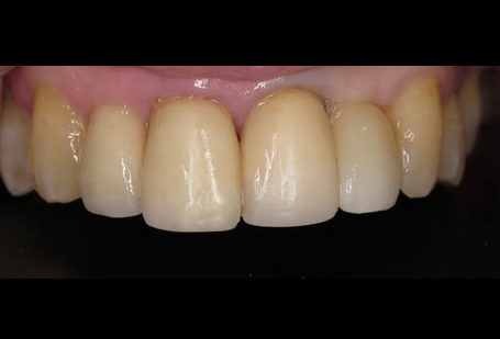 Facial Pain Due to Previous Extracteion Healed with Implant