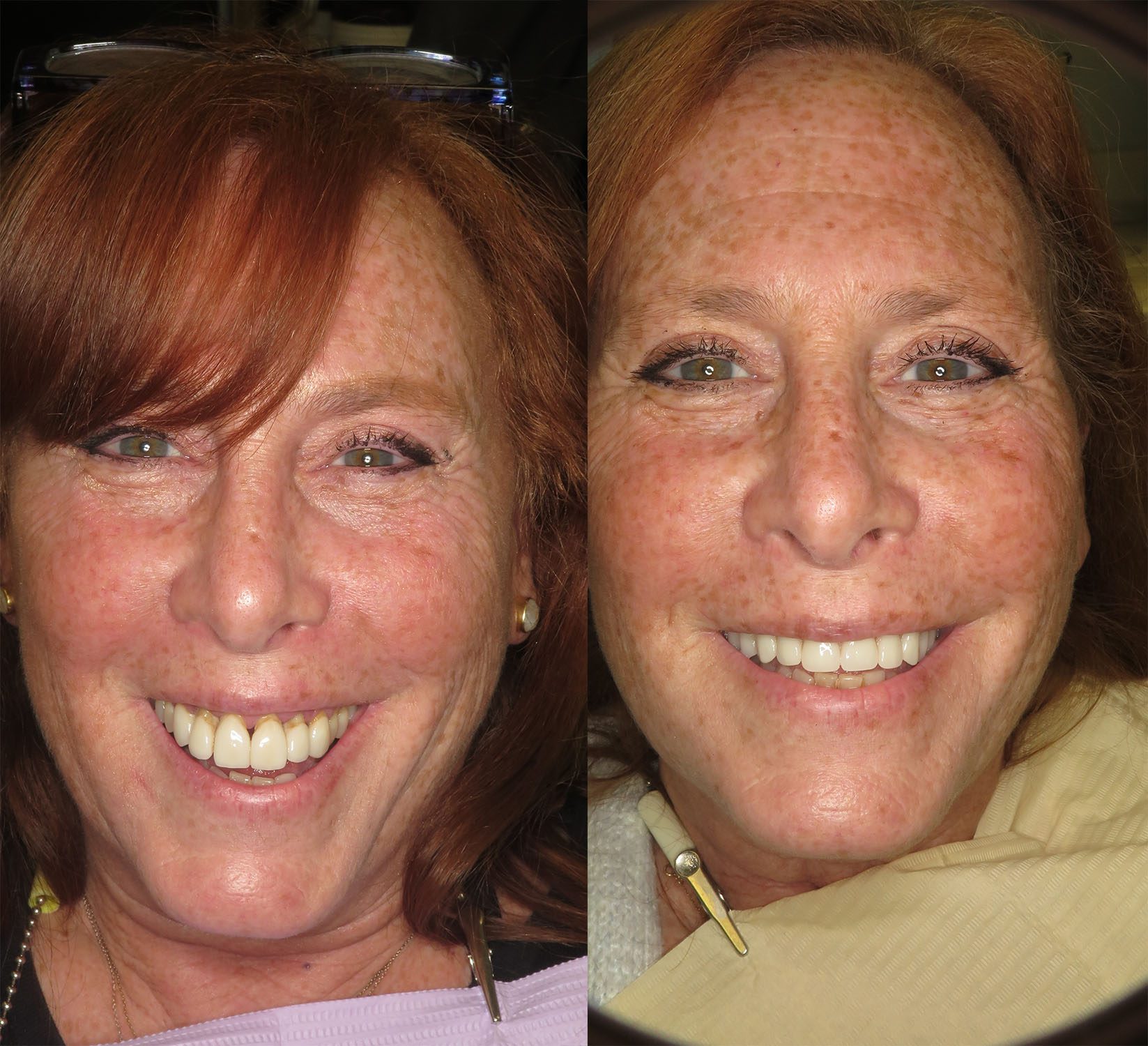 All On 4 for Broken Teeth