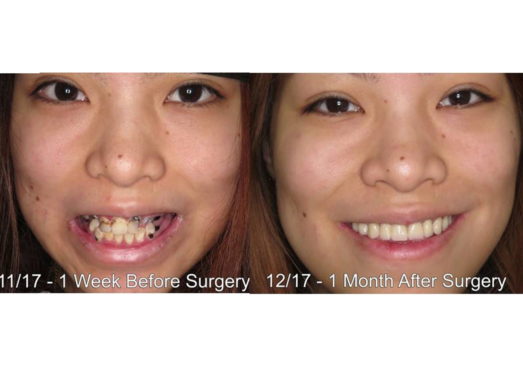 Young Patient’s Smile Restored With All on 4