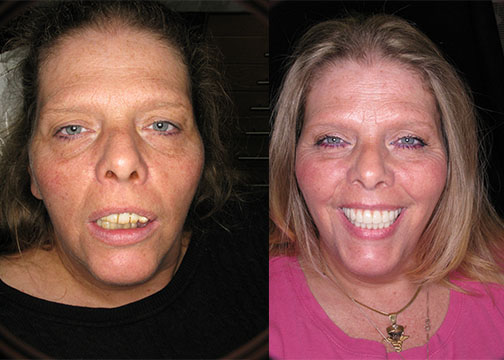 Previous Failed Implants and Other Treatments