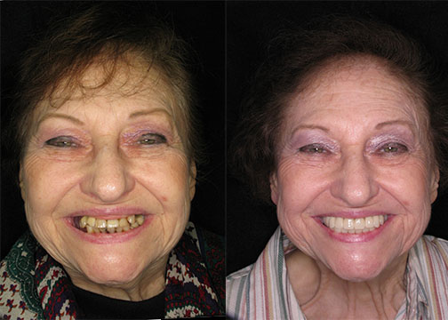 From No Function to a Natural Smile