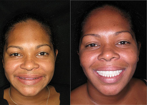 All On 4 Treatment for Amelogenesis Imperfecta