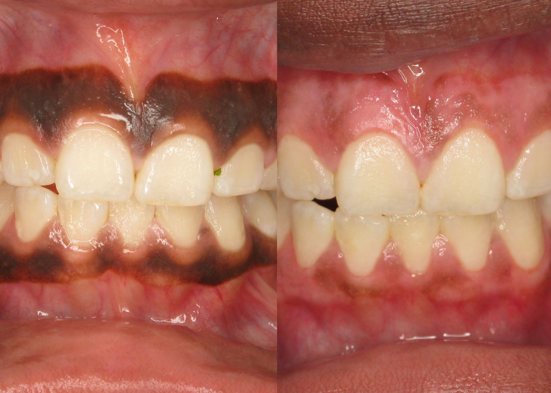 Gums Lightened with Gum Depigmentation