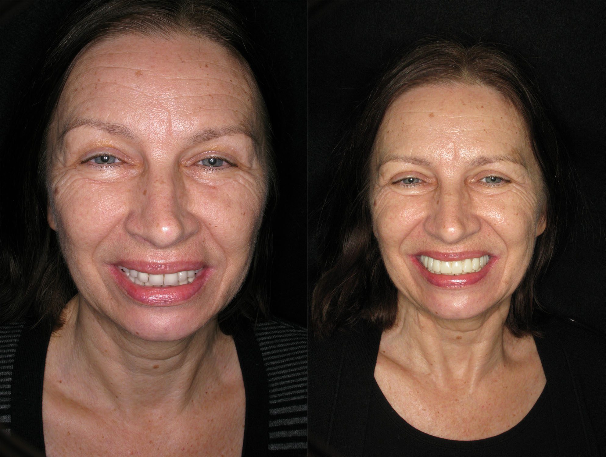 Dentures Replaced with a Smile in A Day