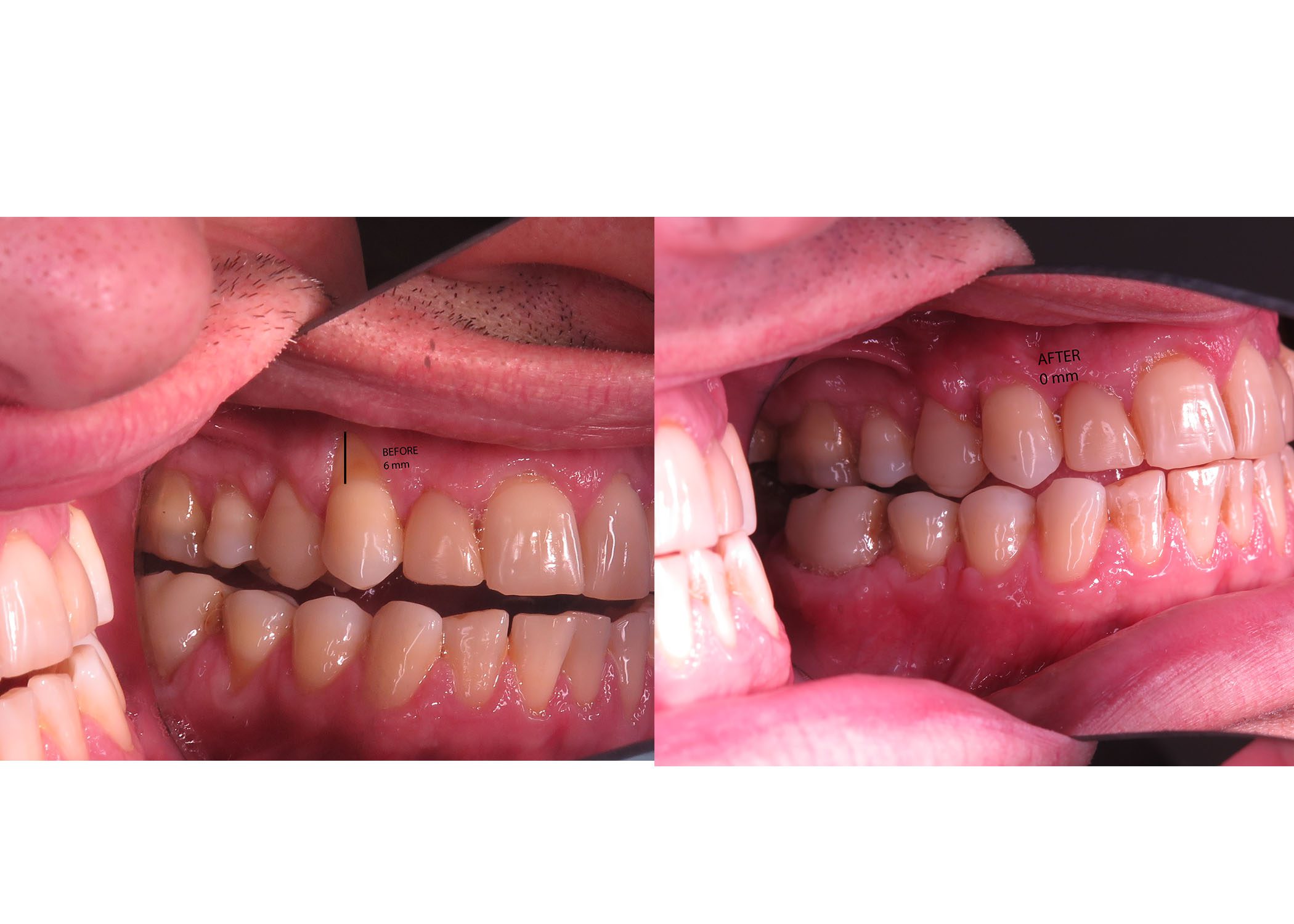 Improve Gum Health