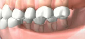 Full Jaw Loss New York City