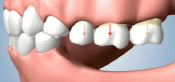 Effects of Missing All of Your Teeth