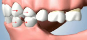 Shrinking of the Jaw Bone from Missing Teeth