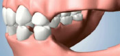 Loss of Natural Jaw Shape