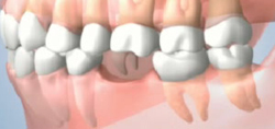 What Happens When You Lose a Tooth
