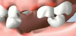 Single Tooth Loss New York City