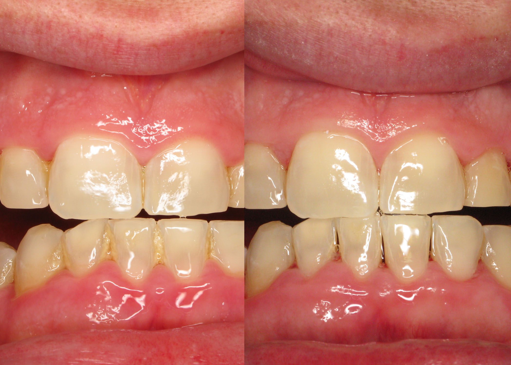 LANAP Used to Deep Clean Periodontal Disease