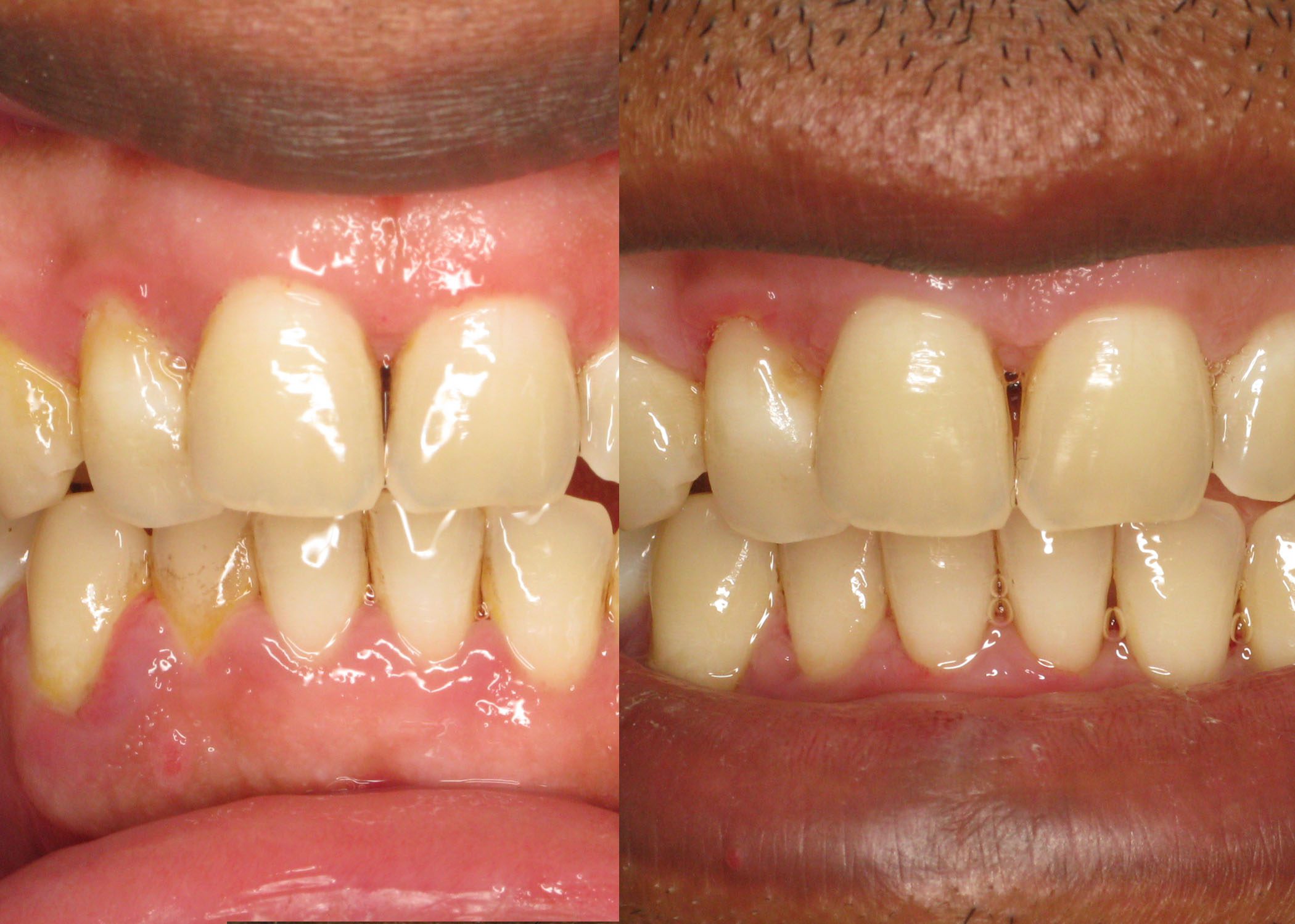 LANAP Used for Moderate Periodontal Disease
