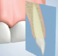 Types of Bone Grafting - Allograft