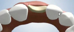 Bone Regrowth for Dental Implant Placement