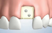 Membrane Placement for Bone Grafting