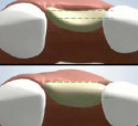 Securing Replacement Teeth