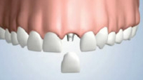 Types of Bone Grafting - Xenograft