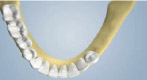 Types of Bone Grafting - Autograft