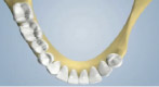 Inadequate Jaw Bone