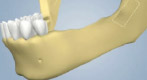 Ramus Extraction for Implant Placement