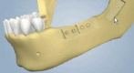 Bone Maturation for Tooth Replacement