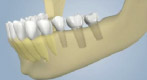 Autograft Dental Implant Placement