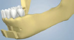 Extracting Bone from the Chin