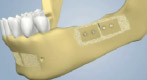 Chin Bone Grafting for Dental Implants