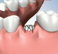 Socket Preservation After Bone Graft