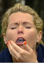 Gagging caused by Full Denture NYC