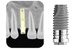 Dental Implant Placement