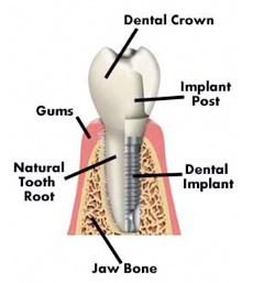 How Do Dental Implants Work?