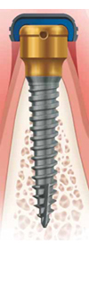 Improved Mini Implant
