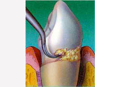 Treatment of Gum Disease