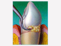 Gum Disease Scaling and Root Planing