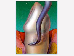 Gum Disease Flap Therapy