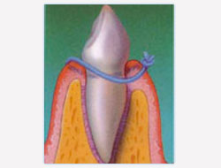Guided Tissue Regeneration